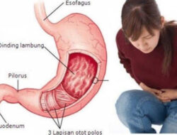 Inilah 7 Cara Ampuh Turunkan Asam Lambung Tanpa Obat
