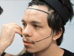 Lagi Trending, Segini Biaya Transplantasi Rambut