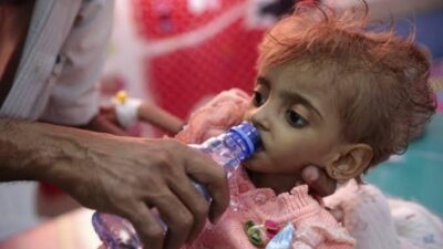 Miris! Ada 540 Ribu Anak di Yaman Menderita Kekurangan Gizi Akut