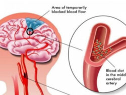 Terkena Stroke? Jangan Panik, Ambil Tindakan Ini