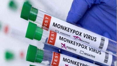 Pasien Cacar Monyet Pengidap HIV Meninggal Dunia di RSCM, Komplikasi Paru Jadi Penyebab Utama