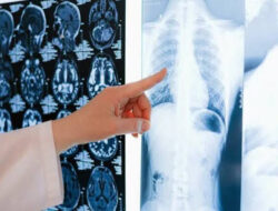 Serplulimab, Terobosan Kalbe untuk Imunoterapi Pasien Kanker Paru